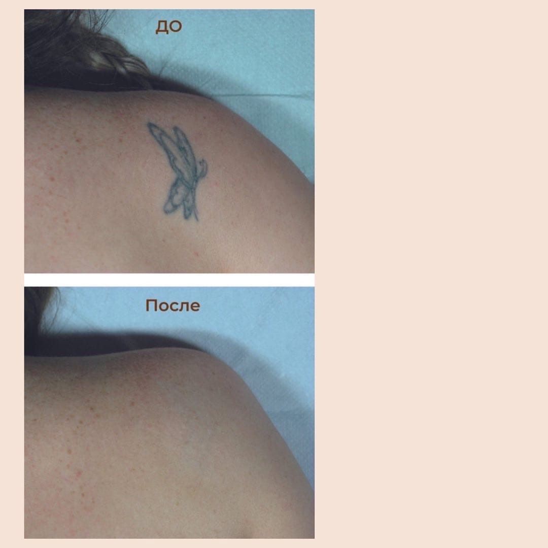 Лазерное удаление татуировок и татуажа Luxea
